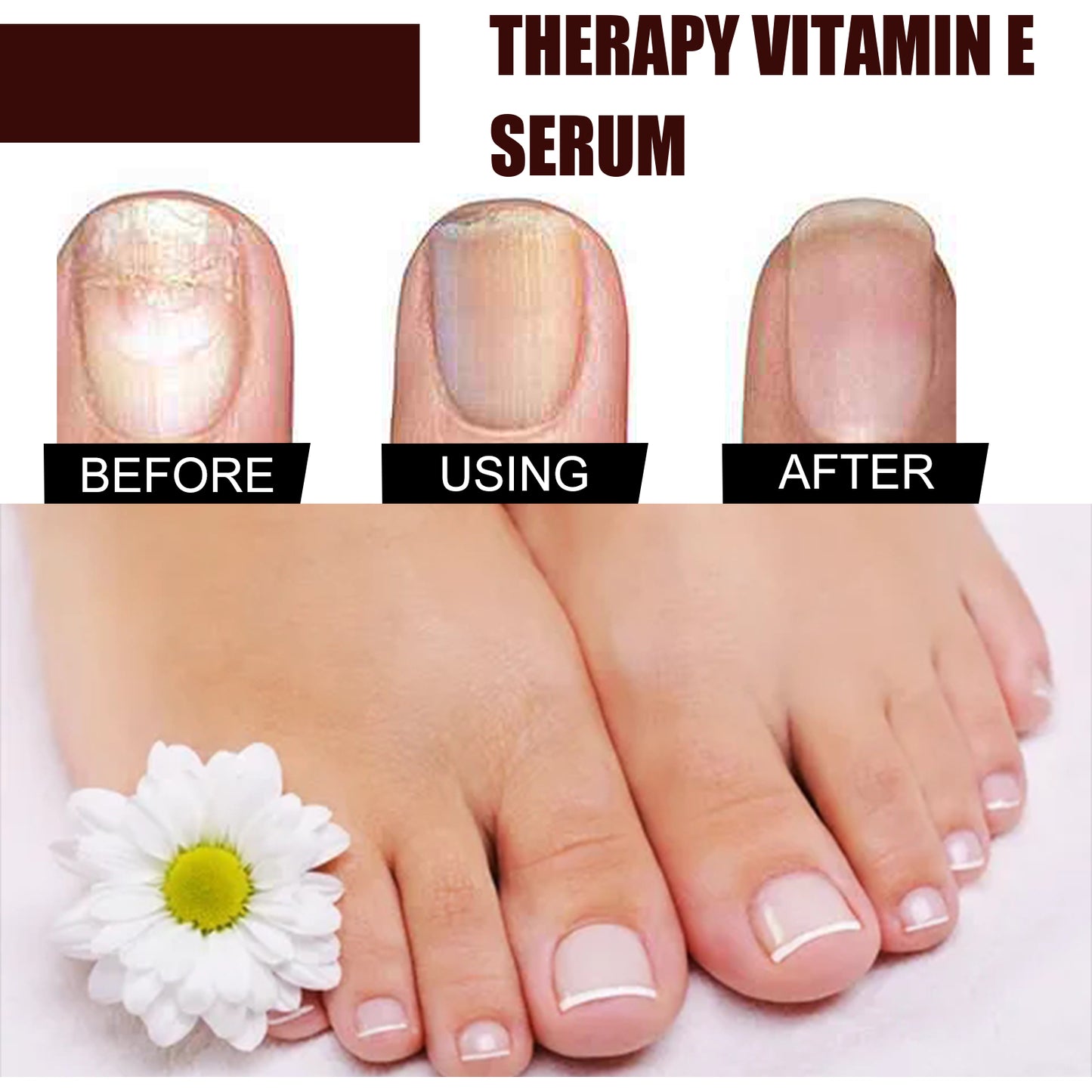 Therapy Vitamin E Serum, Hand And Foot Nail Repair Bright Nail Grey Nail Soft Nail Embedded Nail Care Essence