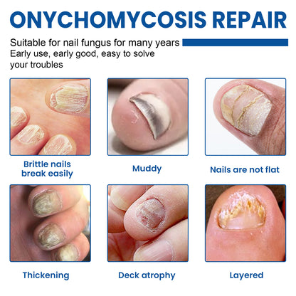 Nail Fungus Patches, Repair Hand And Foot Nails Inlaid Nail Thickening Gray Nail Brightening Nail Patch